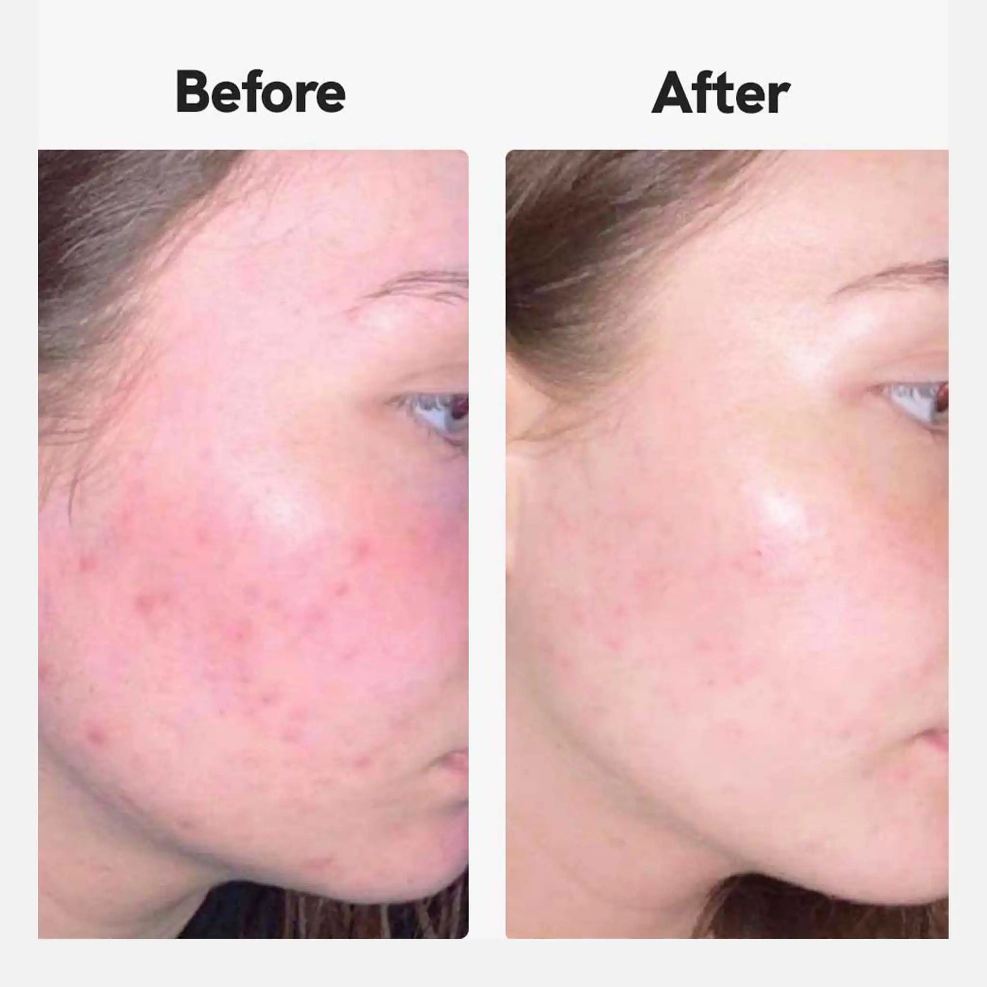 antes e depois da fotografia de um cliente que utiliza o NordicOil Acne Cream