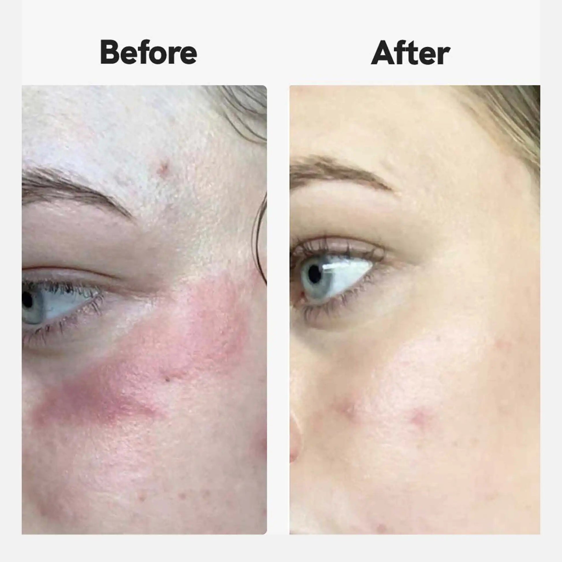 antes e depois da fotografia de um cliente que utiliza o creme eczame do NordicOil