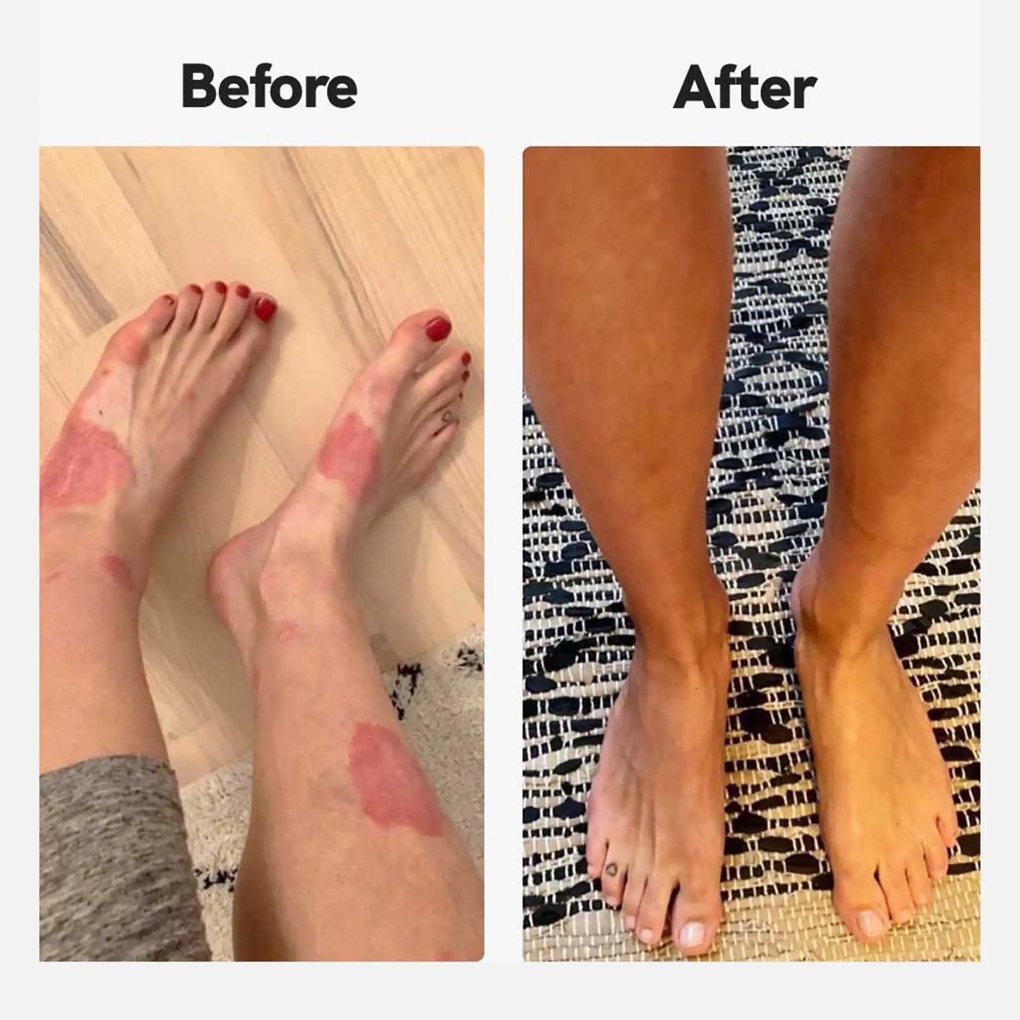 antes e depois da fotografia de um cliente que usa creme de psoríase NordicOil 